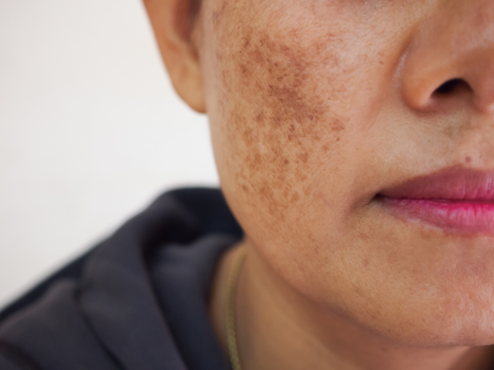 woman suffering from dark spots in DC