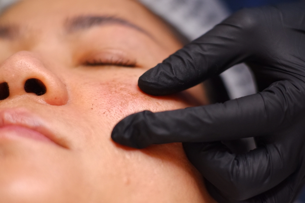 treat melasma Washington DC
