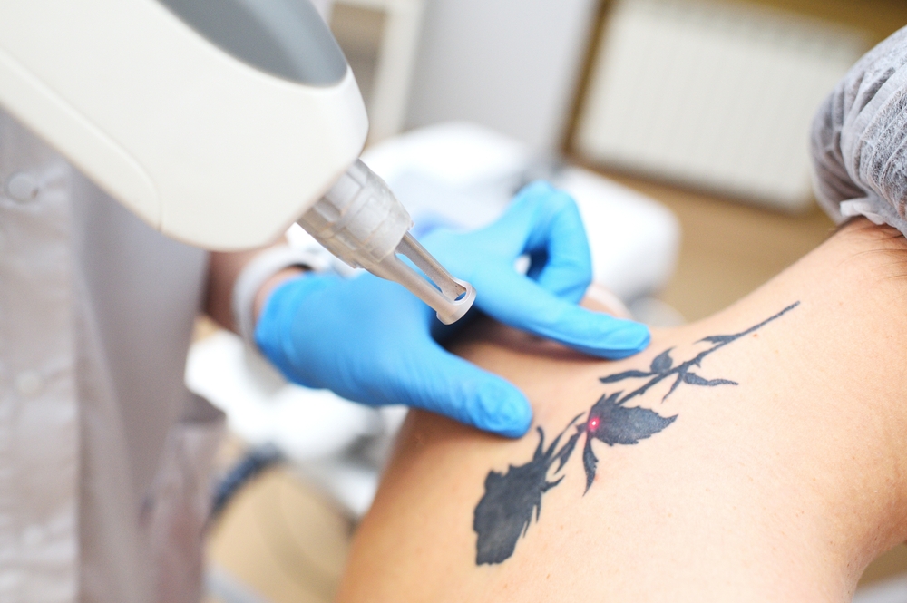 Pico laser tattoo removal DC