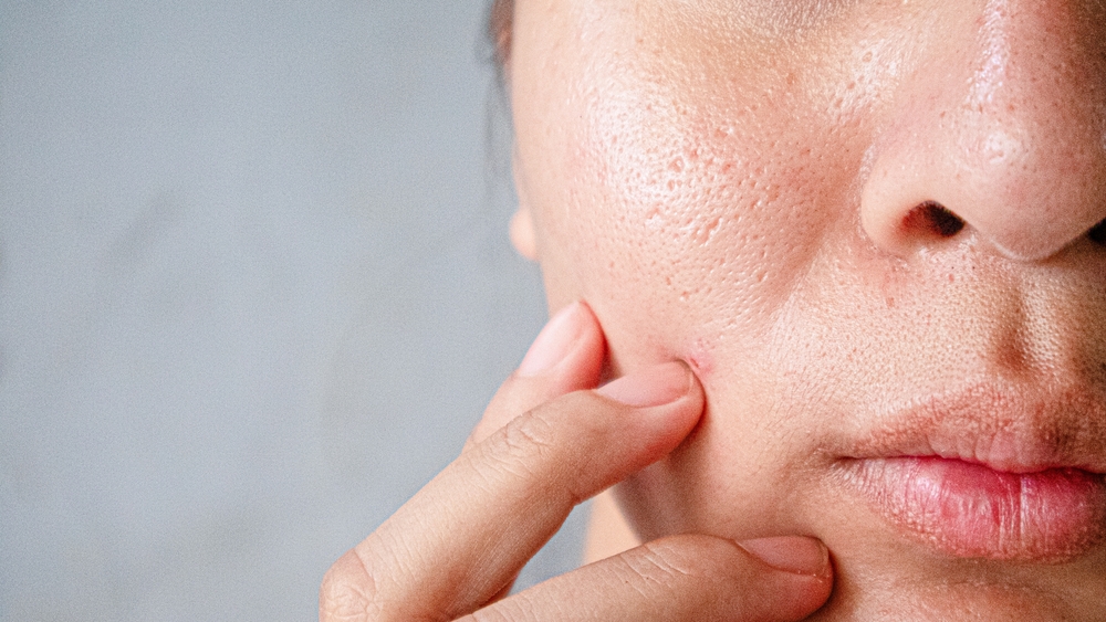 woman with enlarged pores needs a Pico laser in DC