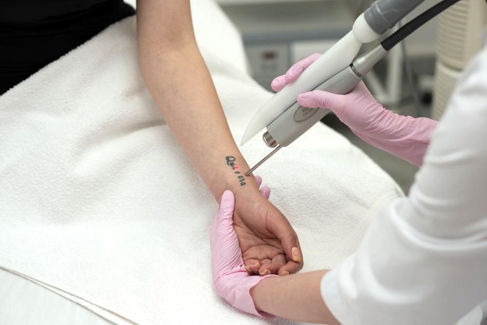 professional tattoo removal in Capitol hill