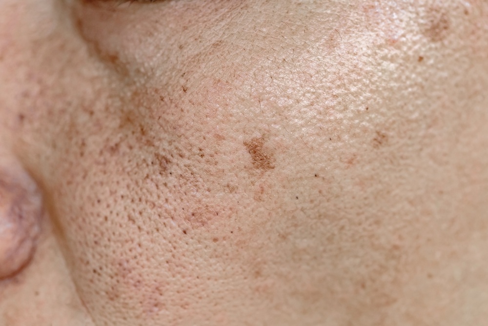 woman in need of Pico laser for dark spots in DC