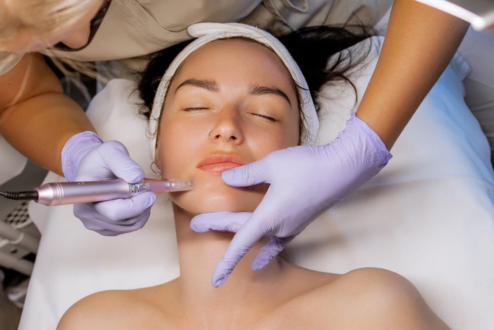 woman getting a Microneedling Treatment in Capitol Hill